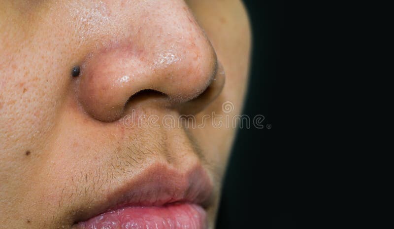 Black Mole Behind Nose Need Co2 Laser To Removal Blackheads Acne