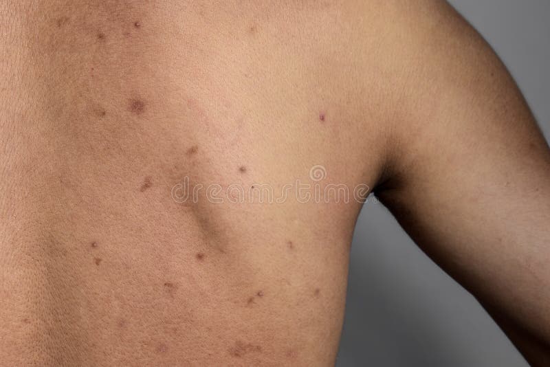 373 Pimples Back Stock Photos Free And Royalty Free Stock Photos From