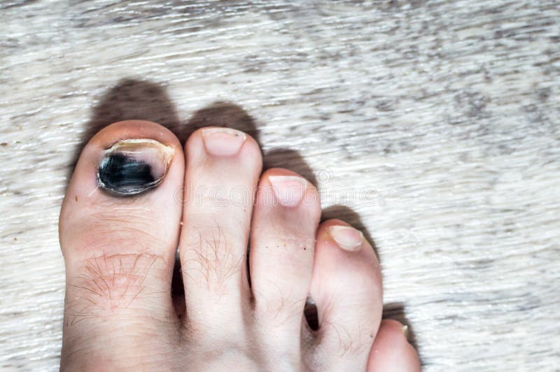 Blackened Nail on a Man`s Big Toe. Nail Injury Stock Photo - Image of ...