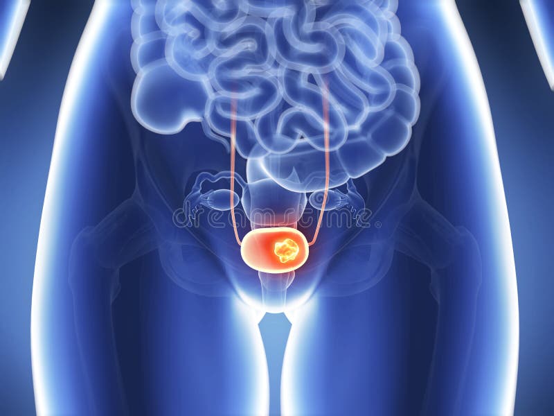 Bladder cancer