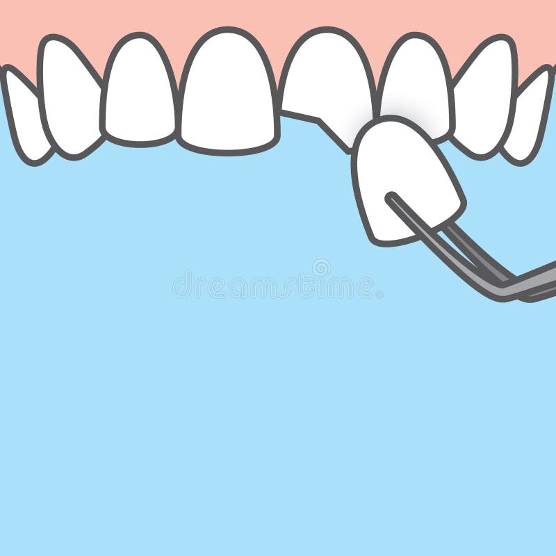 Blank banner Upper Veneer tooth illustration vector on blue background. Dental concept stock illustration