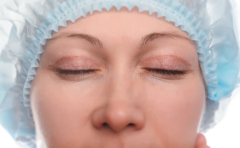 Blepharoplasty of the upper eyelid. An operation that removes the excess ugly skin of the eyelids above the eyes. The eyes are closed. Photos are taken at different times to track the healing process of the skin. Two months after the operation.
