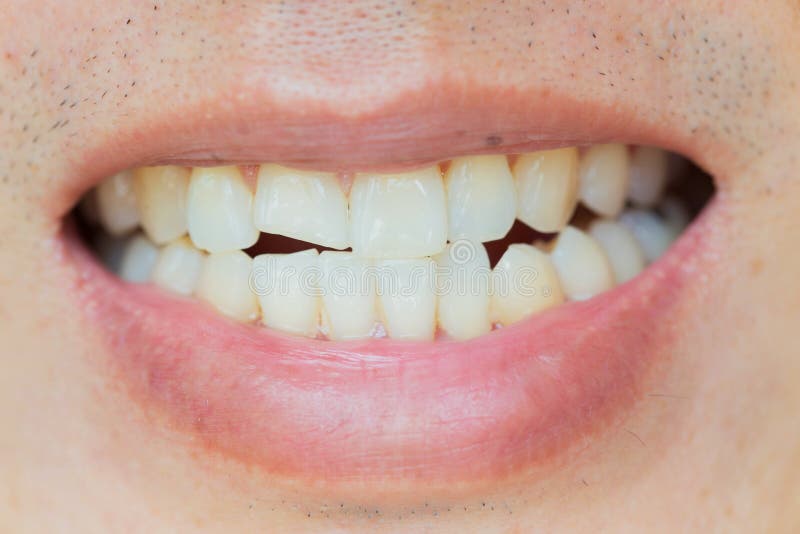 Blessures de dents ou dents rodage le mâle Traumatisme et dommages de nerf de dent blessée image stock Blessures de dents ou dents rodage le mâle Traumatisme et dommages de nerf de dent blessée image stock