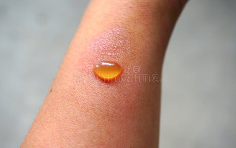 Blister On Skin A Small Pocket Of Fluid Within The Upper Layers Stock