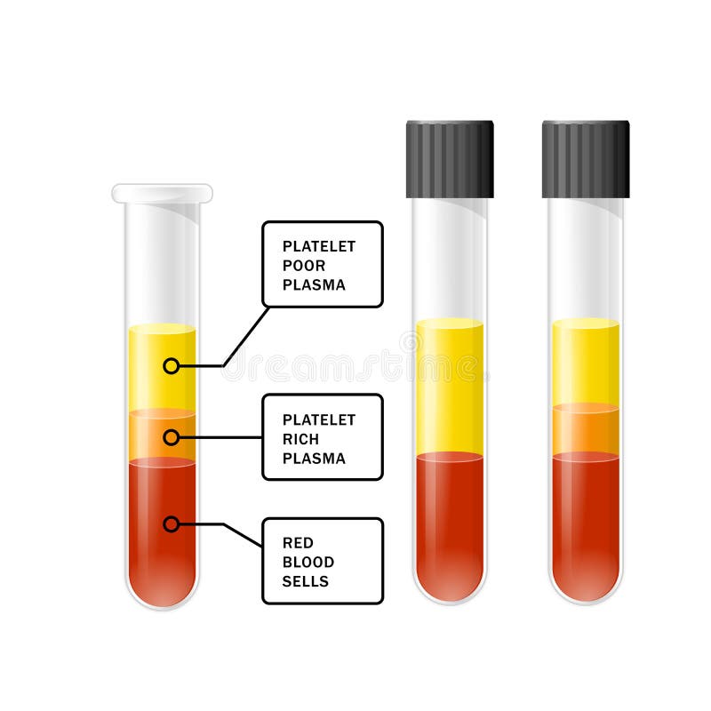 Blod efter avskiljande av trombocyt i centrifugen i provröret, PRP, trombocyt-rikt plasma stock illustrationer Blod efter avskiljande av trombocyt i centrifugen i provröret, PRP, trombocyt-rikt plasma stock illustrationer