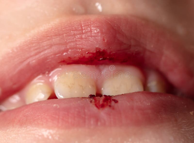 Blood on the boy`s lip stock image. Image of medicine 143583781