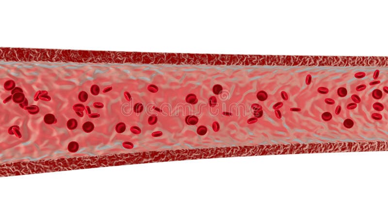 Closeup Of A Atherosclerosis- 3D Rendering Stock Illustration