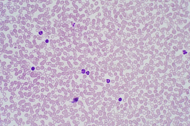 White Blood Cells Of A Human, Photomicrograph Panorama As Seen U Stock 94F