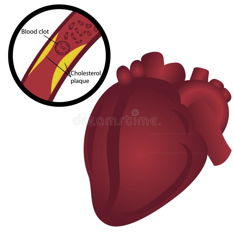 Blood Clot Cholesterol Plaque in Artery Heart Attack Stock Vector