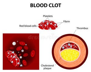 Blood Clot Formation Diagram Blood Clot Formation Diagram