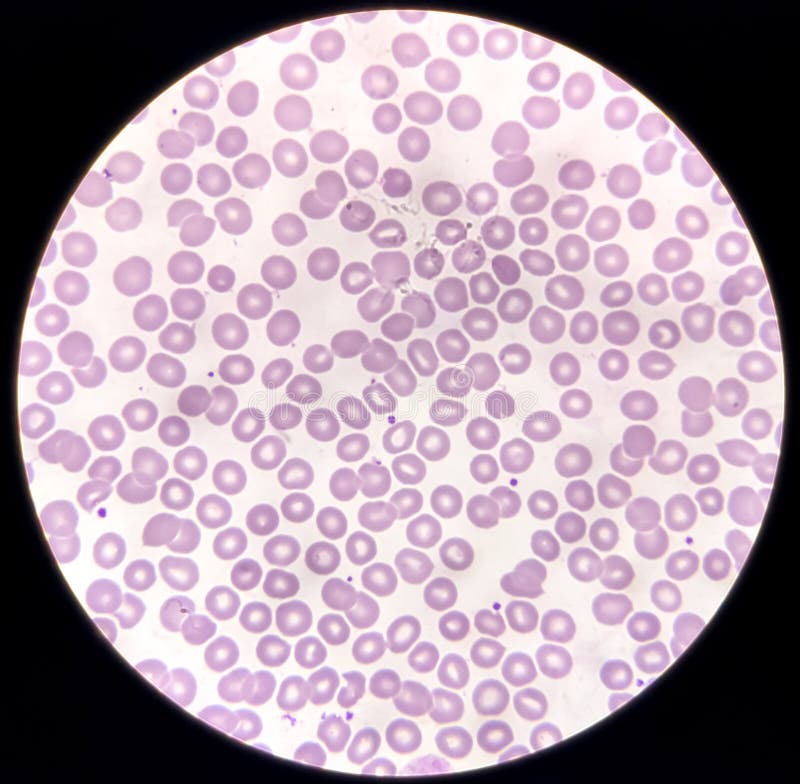 Blood Film Microscopic Show Decrease Platelets Leucocyte (WBC). Stock