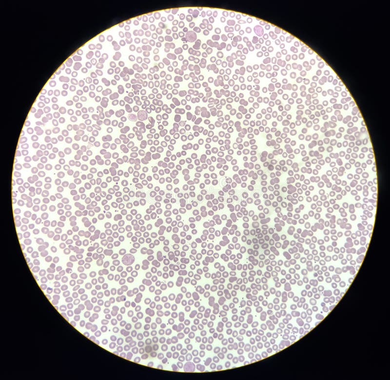 Blood Film Showing a Decrease of Platelets and White Blood Cells