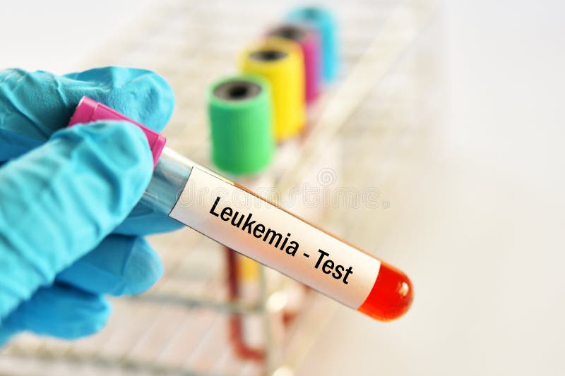 Blood for Leukemia Cells Test Stock Image Image of eosinophil