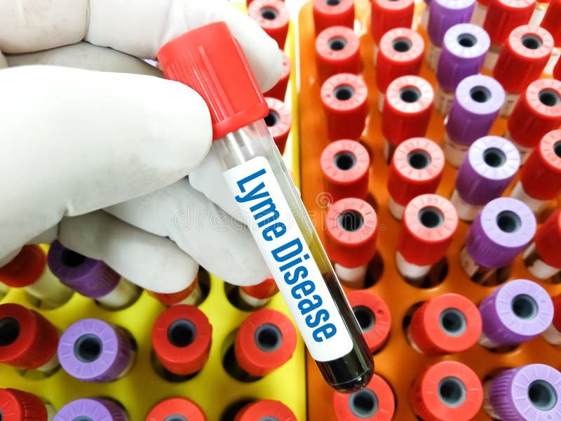 Blood Sample for Lyme Disease Test. Stock Image Image of hospital