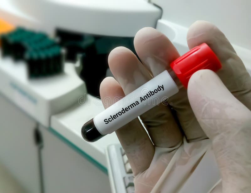 Blood Sample for Scleroderma. CREST Syndrome Stock Image Image of