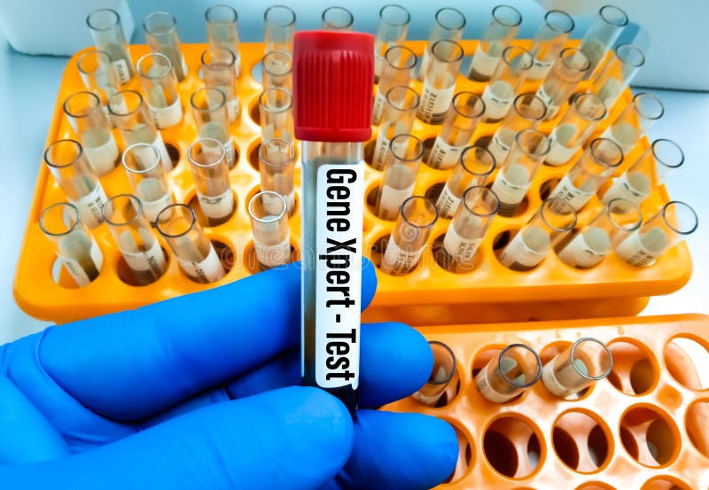Blood Sample for Vibrio Cholerae Test Stock Image Image of hematology