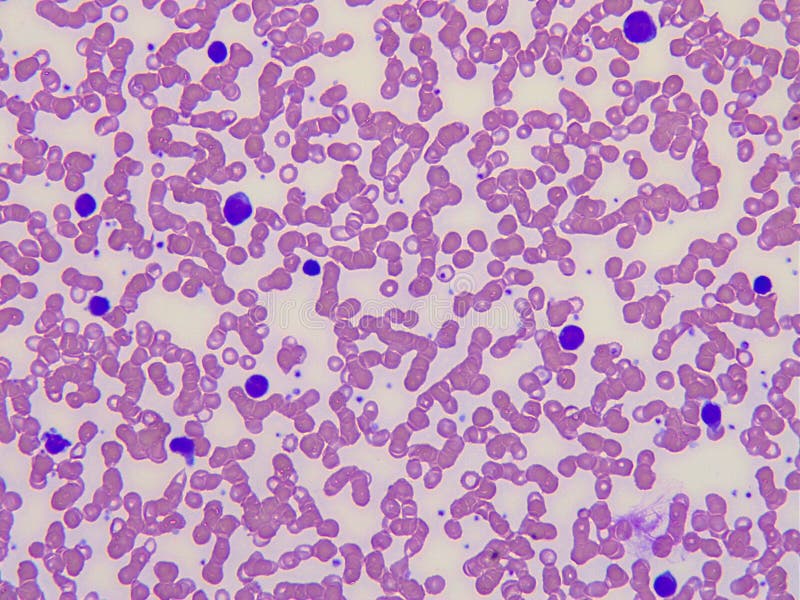 Blood smear of a patient with infections mononucleosis