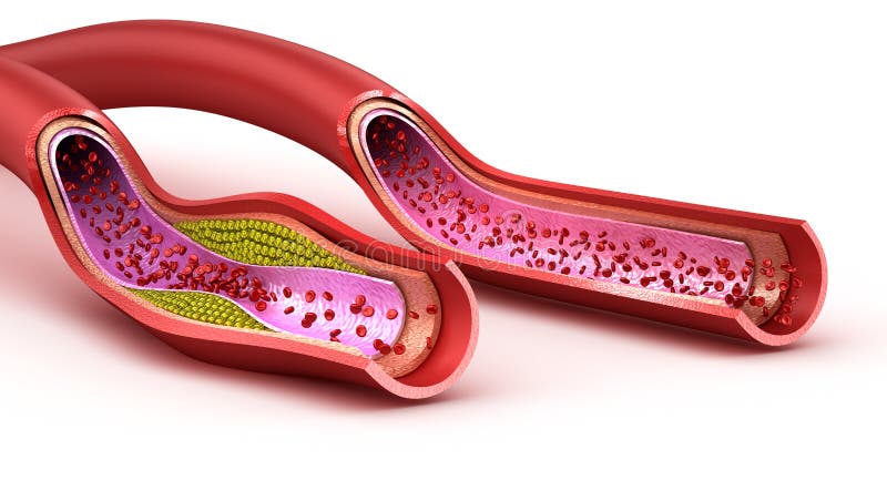 Blood vessel : normal and cholesterol damaged vessel stock illustration Blood vessel : normal and cholesterol damaged vessel stock illustration
