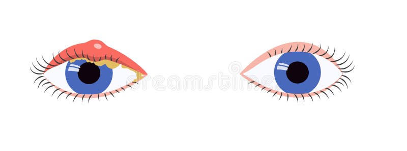Blepharitis Eye Stock Illustrations – 72 Blepharitis Eye Stock  Illustrations, Vectors & Clipart - Dreamstime
