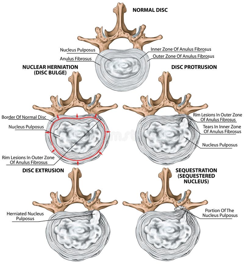 BOARD Types and Stages of Lumbar Disc Herniation Stock Illustration