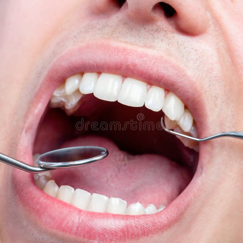 Boca Masculina Humana Que Muestra Los Dientes Con El Destral Dental Y