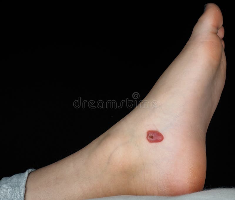 Bolla Di Sangue In Bocca Bolla di sangue immagine stock. Immagine di barretta - 34687531