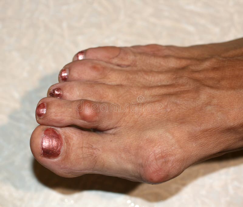 A Bone On The Foot Bump On The Toe Stock Photo Image Of