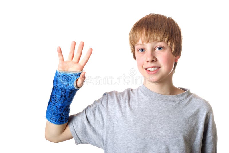 Bone healed, ready for the cast to be taken off royalty free stock photo