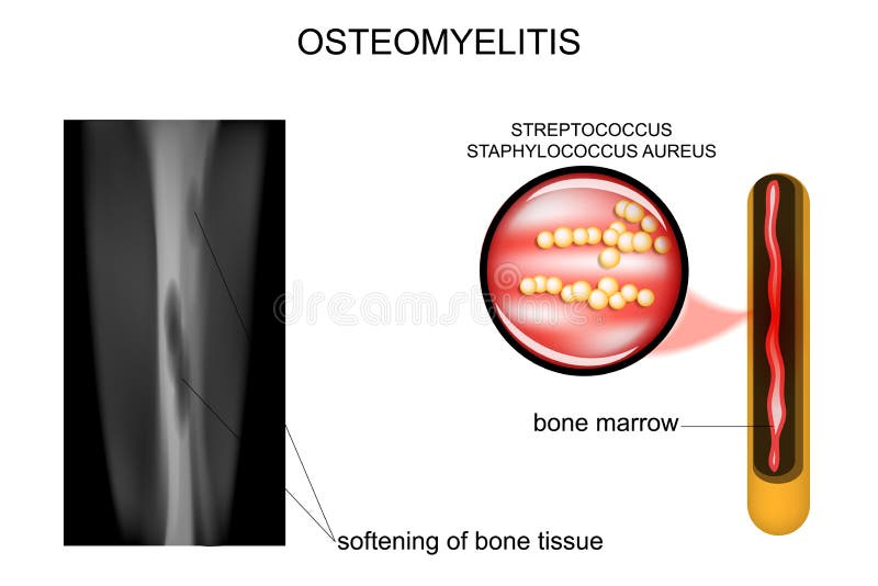 Osteomyelitis is Infection in the Bone. Closeup Bacteria Staphylococcus Aureus that Caused this