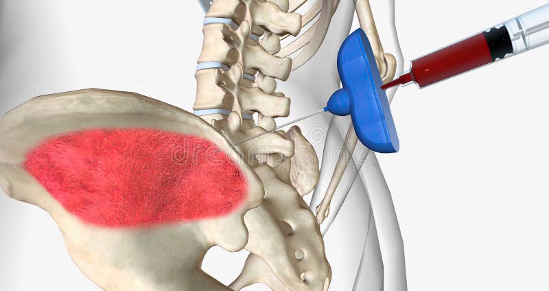 Bone Marrow Aspiration is a Procedure in Which a Liquid Bone Marrow