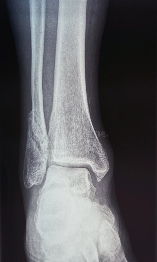 A Bone on the Foot. Bump on the Toe. Stock Photo Image of