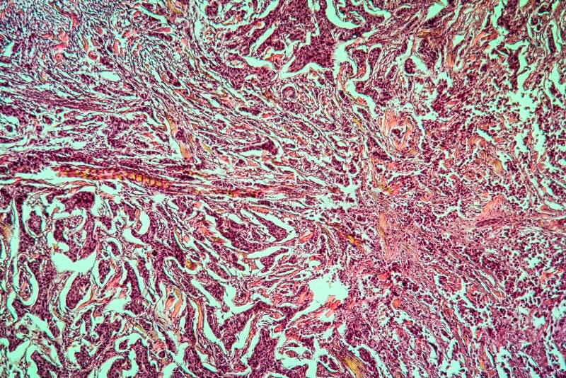 Breast cancer of the woman diseased tissue 100x. Breast cancer of the woman diseased tissue 100x