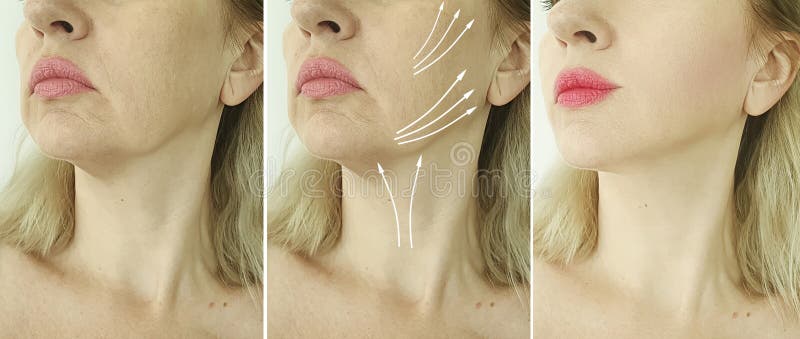 Woman face wrinkles before and after treatment tension thread lifting effect problem. Woman face wrinkles before and after treatment tension thread lifting effect problem