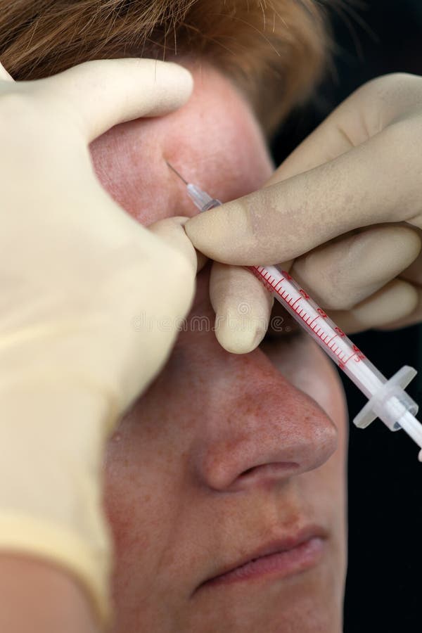 BOTOX® έγχυση στοκ φωτογραφία BOTOX® έγχυση στοκ φωτογραφία