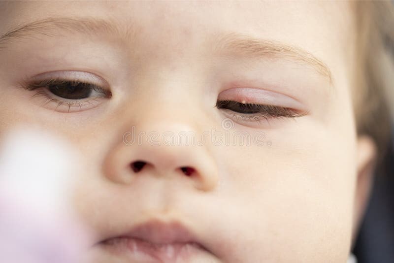 Bouton Blanc Sur La Paupiere Superieure De L Oeil Milium Inflammation De L Oeil D Un Petit Enfant De Bebe Conjonctivite Le Mili Photo Stock Image Du Conjonctivite Pustule Bouton Blanc Sur La Paupiere Superieure De L Oeil Milium Inflammation De L Oeil D Un Petit Enfant De Bebe Conjonctivite Le Mili Photo Stock Image Du Conjonctivite Pustule