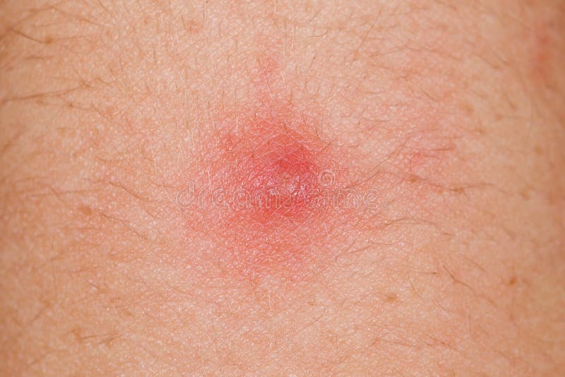 Un Gros Bouton Rouge Sur L'épaule D'un Homme, Inflammation De La Peau Sur  Fond Blanc Isolé. Banque D'Images et Photos Libres De Droits. Image 87327794