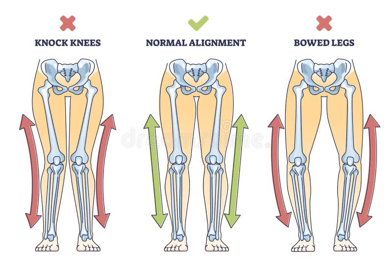 Bowed legs syndrome with normal and knock legs comparison outline diagram