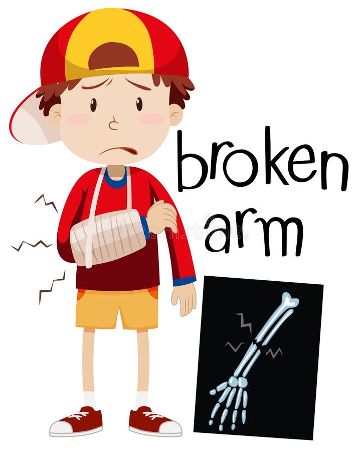 Boy with broken bone and x-ray. 