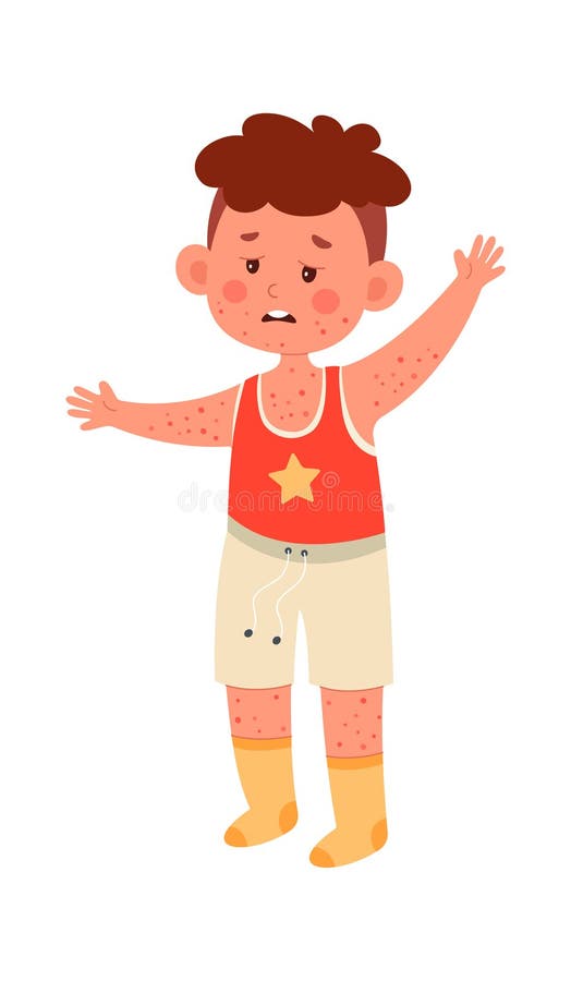 Boy with Chickenpox stock vector. Illustration of skin 276210234