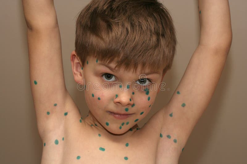 Как выглядит ветрянка фото прыщиков Boy with Green Dots stock image. Image of blisters, virus - 584179