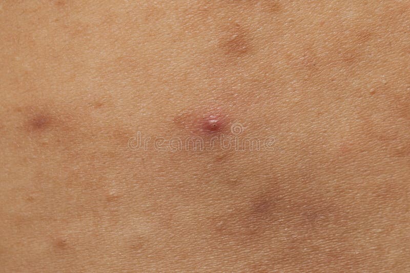 Acne Scars And Keloids In The Chest Of Man Stock Photo Image Of