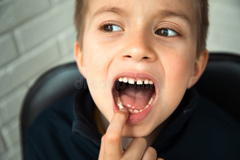 A boy of 6-7 years old shows the first teeth that grow after the loss of milk teeth