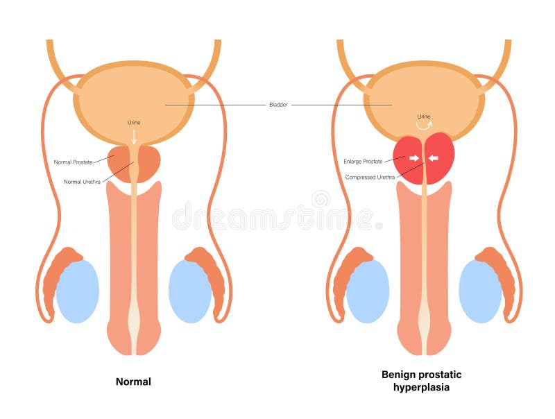 BPH info concept stock vector. Illustration of obstruction 202997123