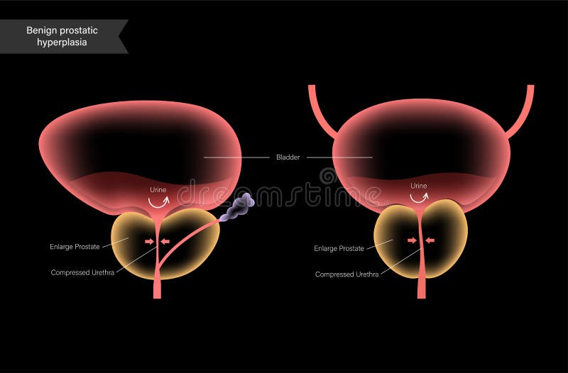 problems of benign prostatic hyperplasia)