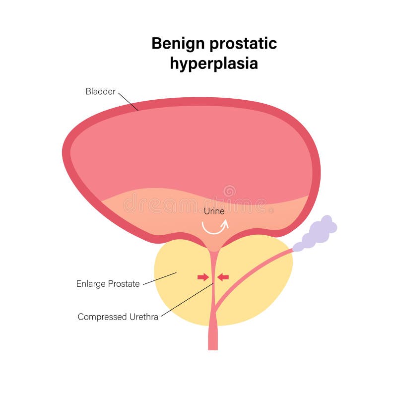 benign prostatic hyperplasia infertility artrózis kezelése gombákkal