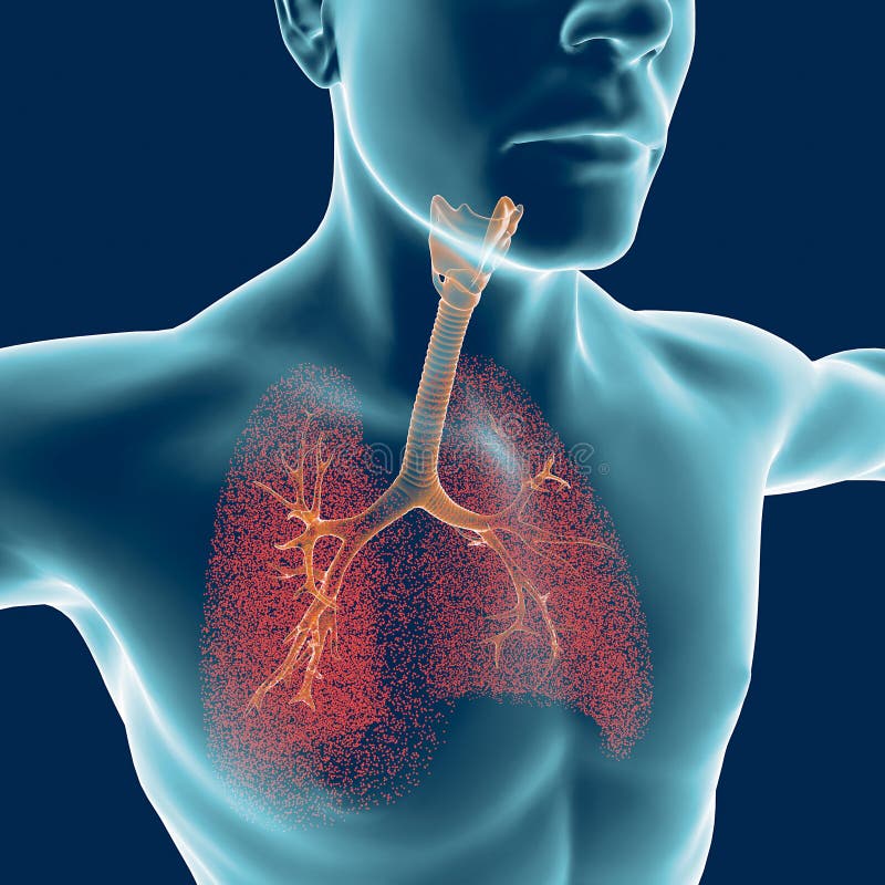 Brônquio, o corpo humano, inflamação ilustração stock Brônquio, o corpo humano, inflamação ilustração stock