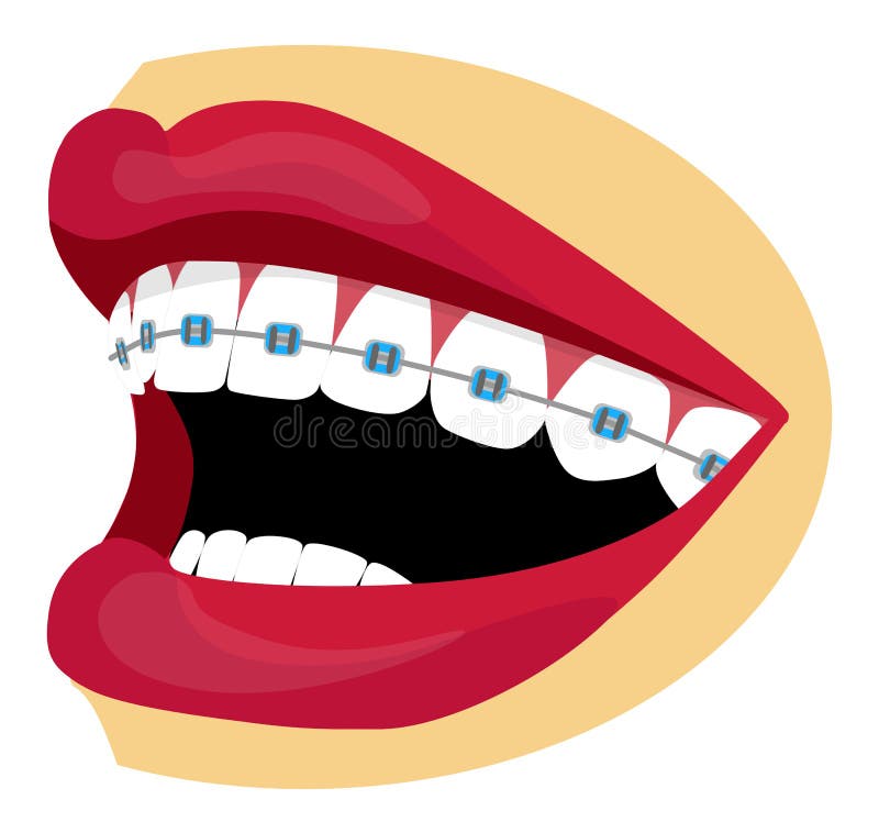 Braces illustration stock vector. Illustration of braces - 34156066