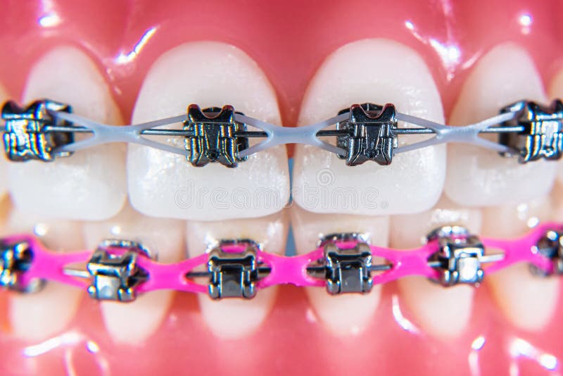 The Braces are Placed on the Teeth in the Artificial Jaw. Macro