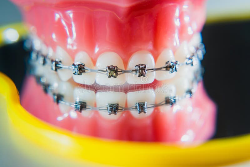 The Braces are Placed on the Teeth in the Artificial Jaw. Macro
