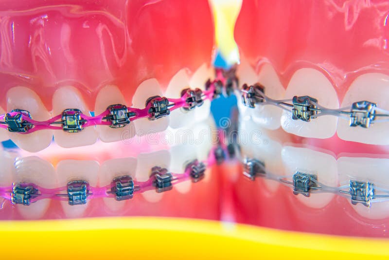 The Braces are Placed on the Teeth in the Artificial Jaw. Macro